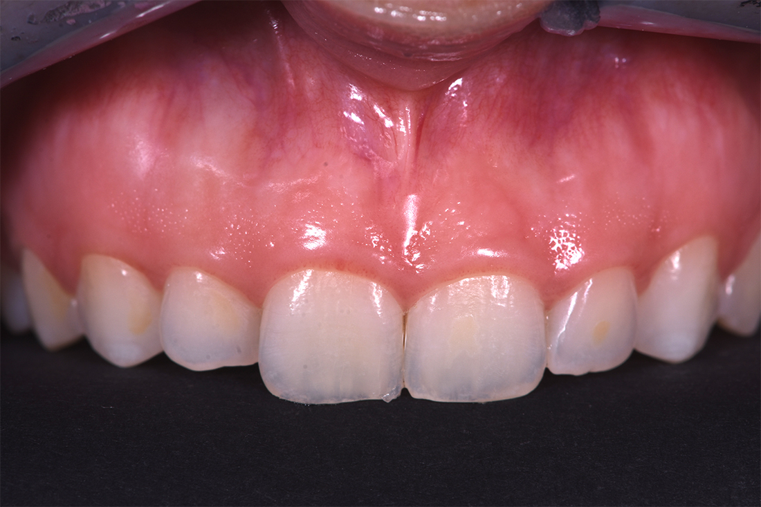 alargamiento dientes cortos-5_despues