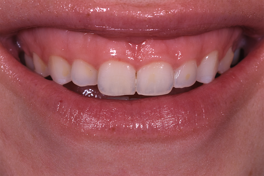 alargamiento dientes cortos-6_antes