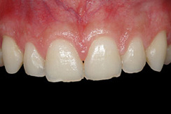 alargamiento dientes cortos-2_despues