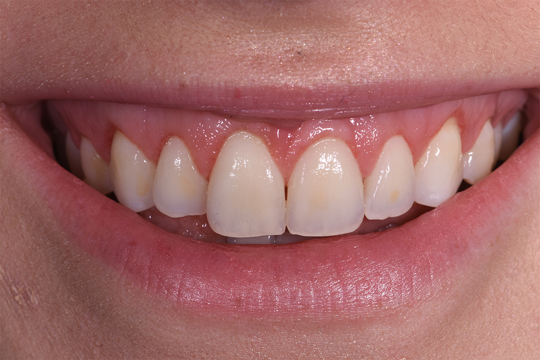 alargamiento dientes cortos-4_despues