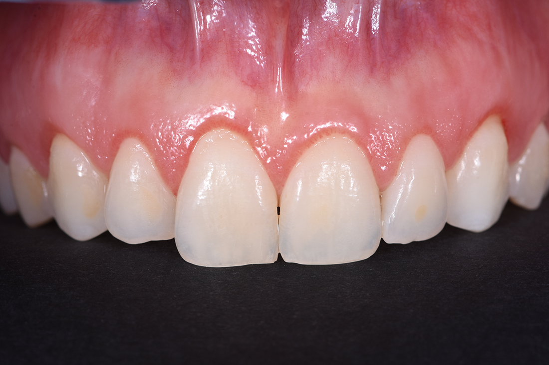 alargamiento dientes cortos-5_antes