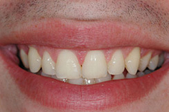 alargamiento dientes cortos-1_despues