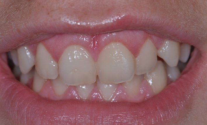 alargamiento dientes cortos-3_despues