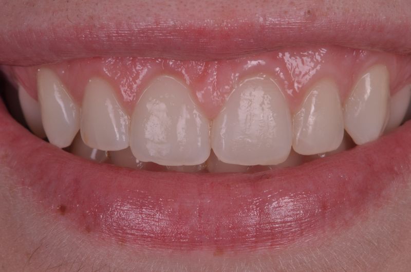 alargamiento dientes cortos-6_despues