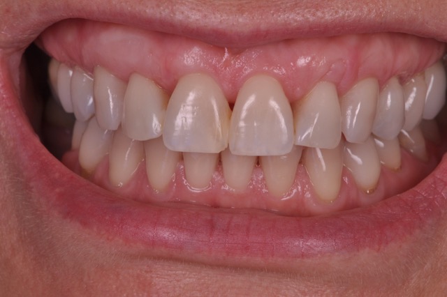 microcirugia periodontal