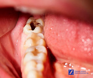 Tratamiento de las Caries: síntomas y diagnóstico