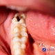 tratamiento caries