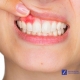gingivitis tratamiento