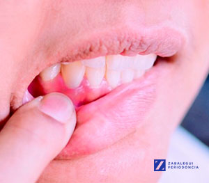 Causas y tratamiento de las encías retraídas