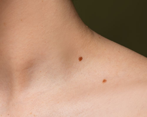 Lesiones-cutaneas-cirugia
