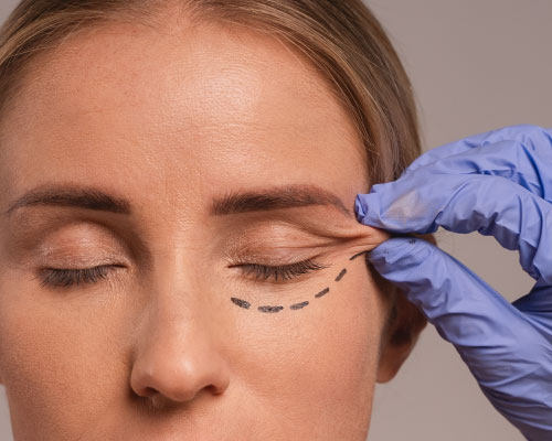 blepharoplasty-zabalegui-facial-surgery