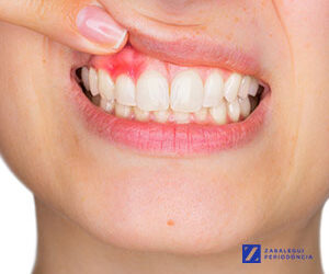 ¿Qué es la gingivitis? Síntomas y tratamiento