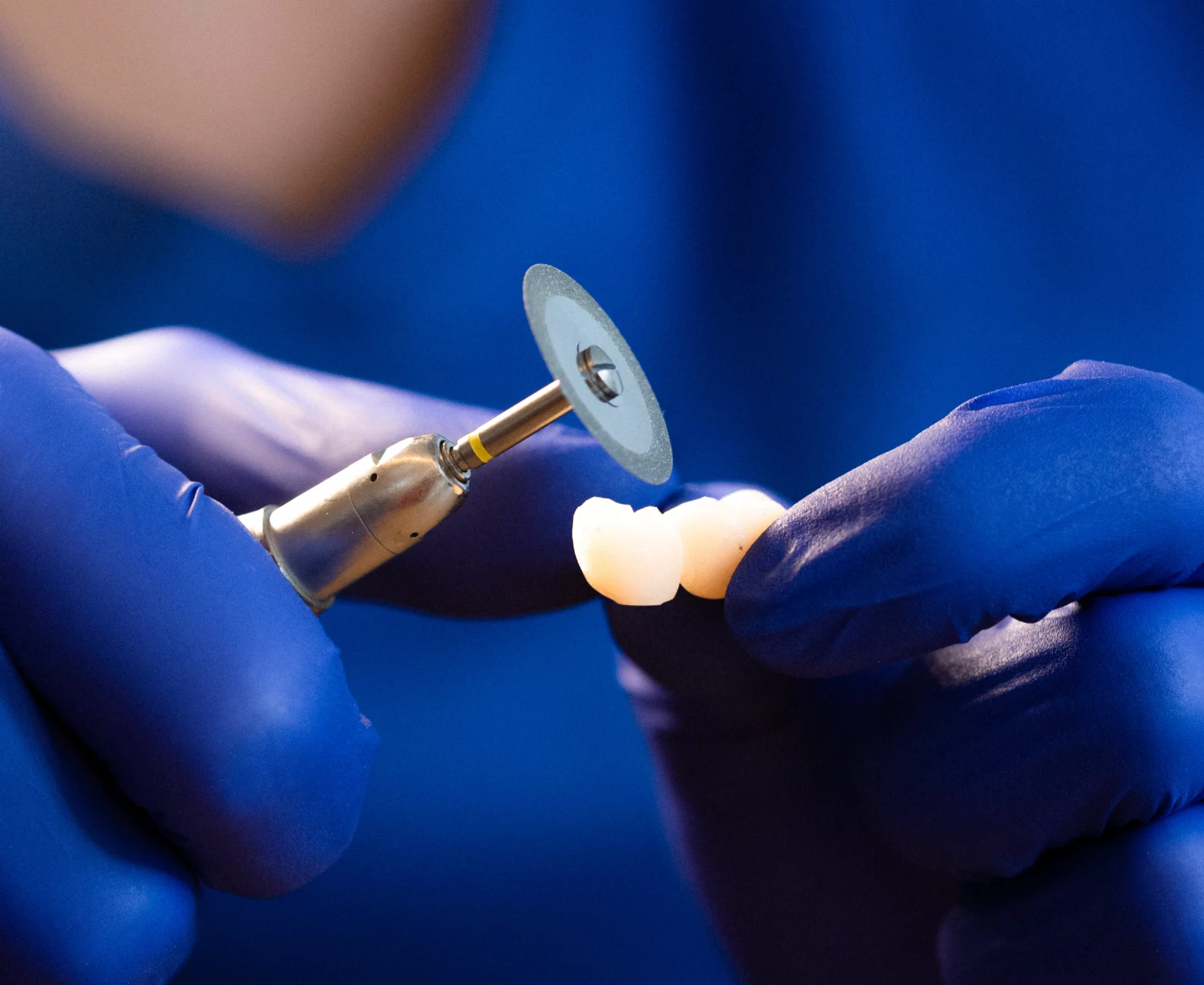 Tratamiento Estética Dental