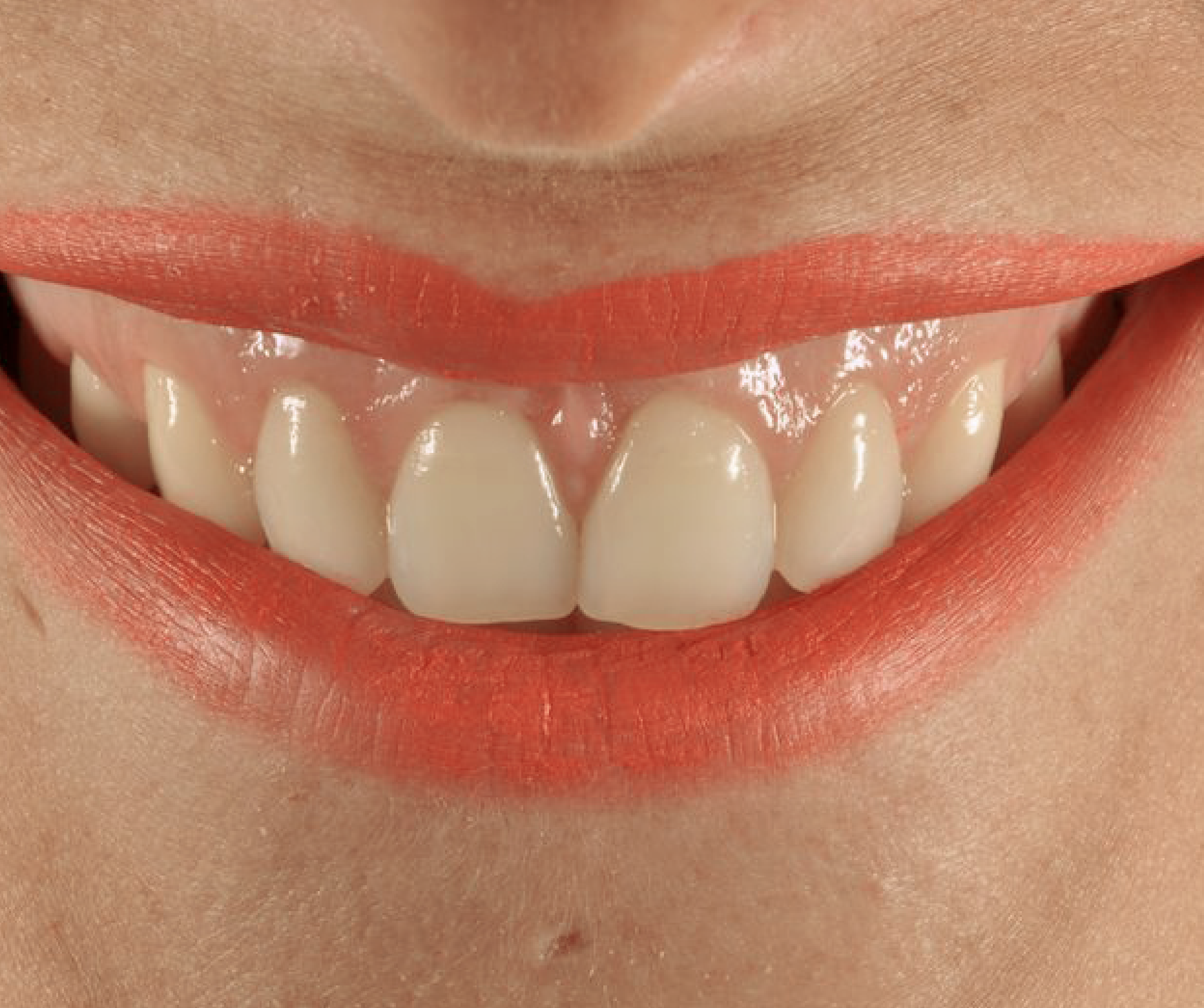 Sonrisa Gingival Cirugía Sonrisa Gingival Cirugía