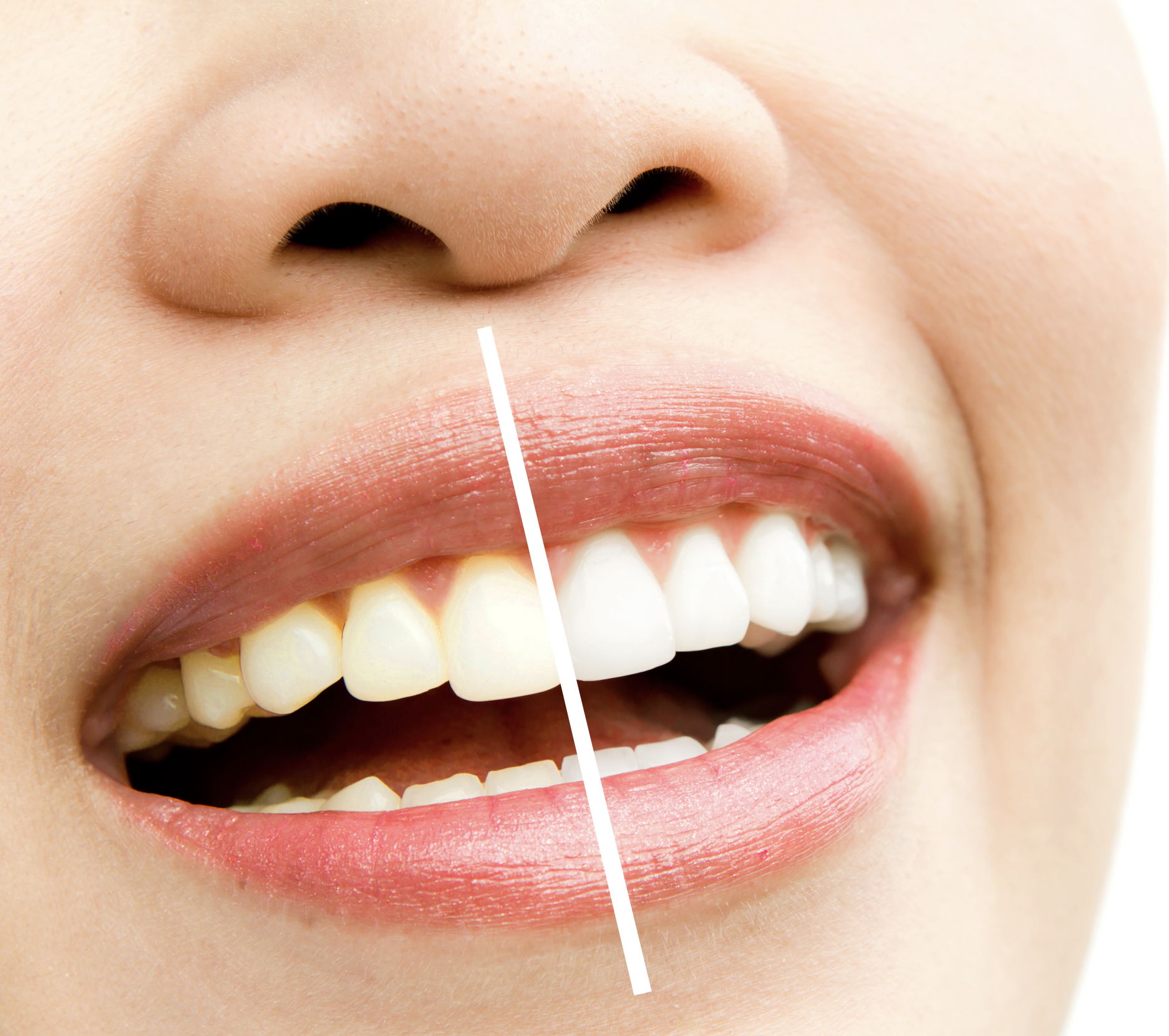 Teeth whitening