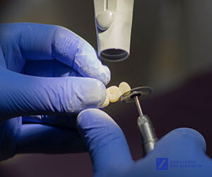 ¿Qué tipos de implantes dentales existen y en qué se diferencian?