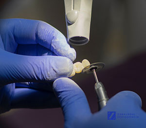 ¿Qué tipos de implantes dentales existen y en qué se diferencian?