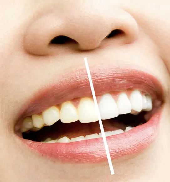 Tipos de manchas dentales