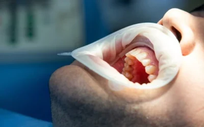 Enfermedades que causan Sangrado de Encías