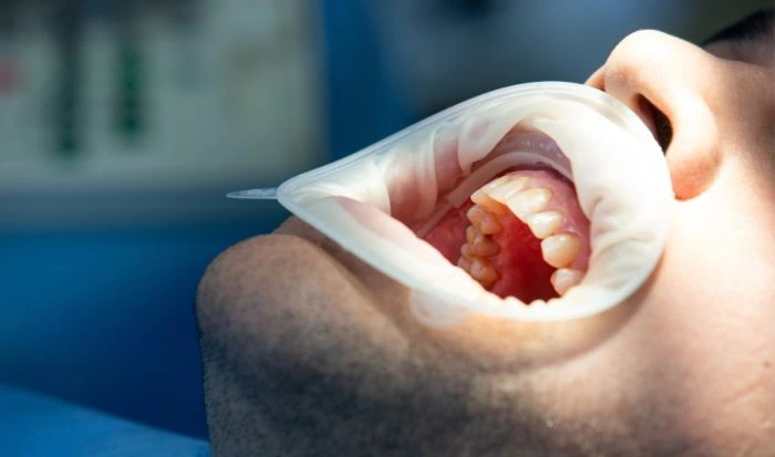 Enfermedades que causan Sangrado de Encías