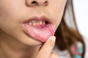 Causas de las llagas en la boca Causas de las llagas en la boca