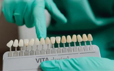 Carillas dentales qué son, tipos y cuándo son la mejor opción para tu sonrisa